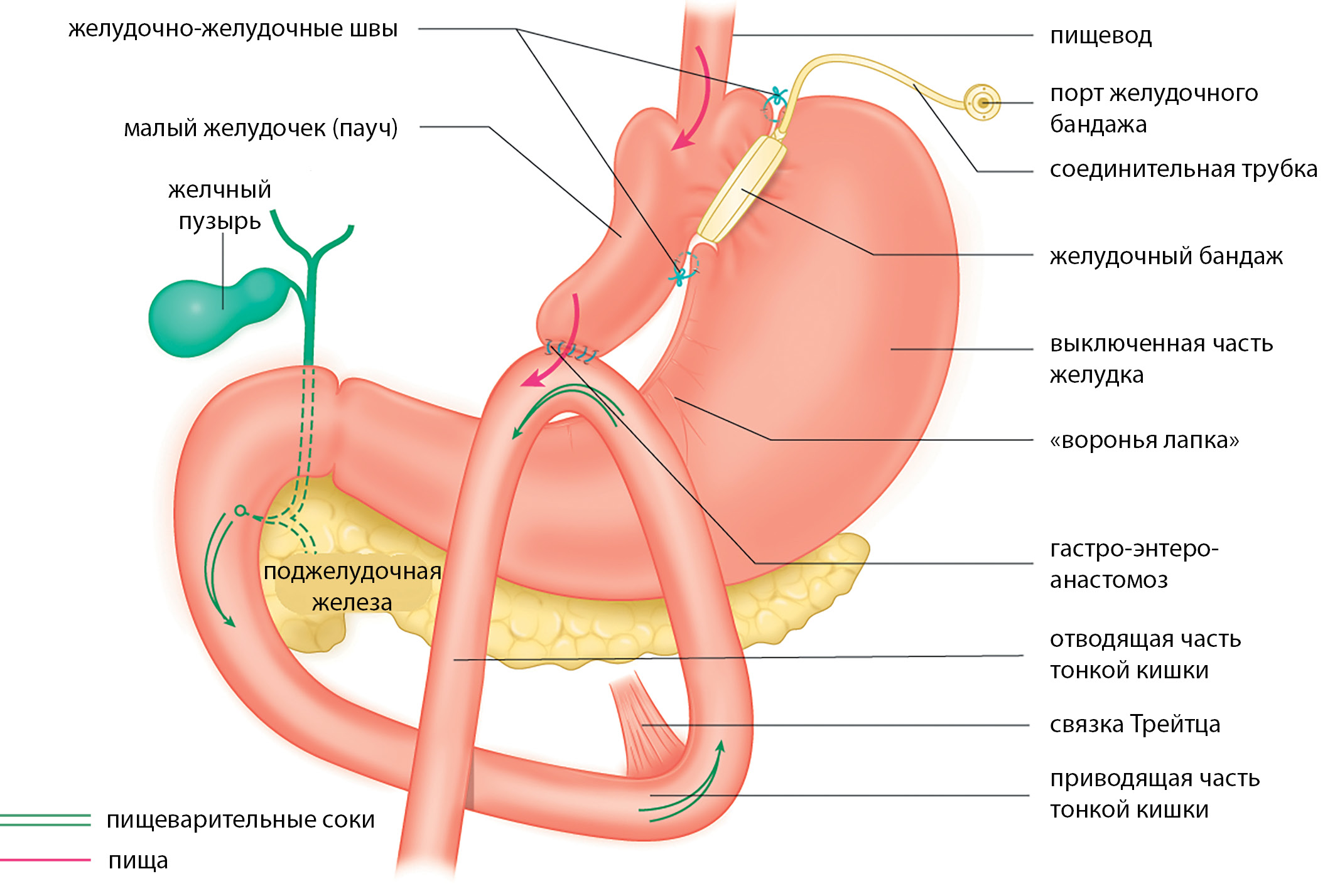 Шунтирование дают инвалидности какую. Гастрошунтирование желудка схема операции. Бариатрическая операция гастрошунтирование. Лапароскопическое гастрошунтирование. Лапароскопическое мини гастрошунтирование.
